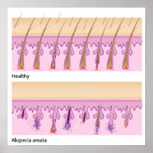 Normal hair and Alopecia areata Poster