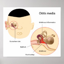 Otitis media Ear infection Poster