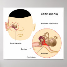 Otitis media Ear infection Poster