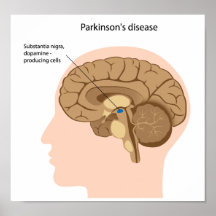 Parkinson's disease Poster