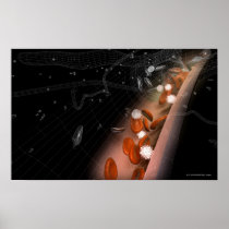 Plaque in the arteries posters