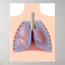 Pneumothorax Poster