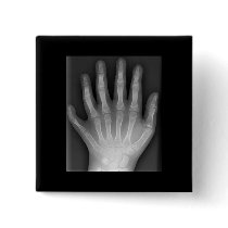 Polydactyly, Six Fingered Hand, X-Ray, rarity! Button