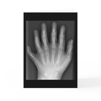 Polydactyly, Six Fingered Hand, X-Ray, rarity! Card