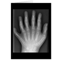 Polydactyly, Six Fingered Hand, X-Ray, rarity! Card