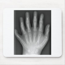 Polydactyly, Six Fingered Hand, X-Ray, rarity! Mouse Pad