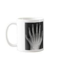 Polydactyly, Six Fingered Hand, X-Ray, rarity! Coffee Mug