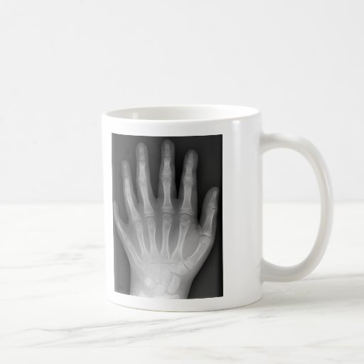Polydactyly, Six Fingered Hand, X-Ray, rarity! Coffee Mug