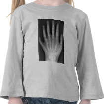 Polydactyly, Six Fingered Hand, X-Ray, rarity! T Shirt