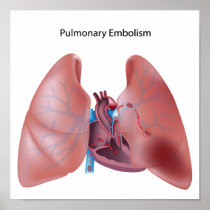 Pulmonary embolism Poster
