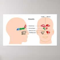 Sinusitis Poster