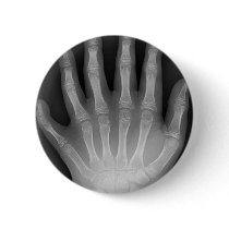 Six Fingered Hand, Medical Rarity, X-Ray Pin