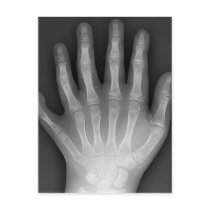 Six Fingered Hand, Medical Rarity, X-Ray Post Cards