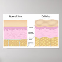 Skin cellulite  Poster