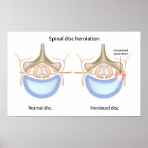 Spinal disc herniation Poster