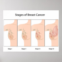 Stages of Breast Cancer Poster