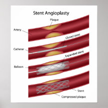 Stent angioplasty Poster