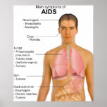 The Main Symptoms Chart For the AIDS Disease posters