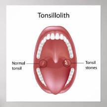 Tonsil stone Poster