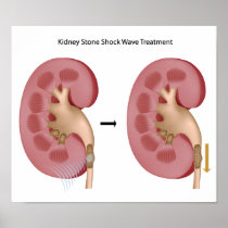 Treatment of kidney stones Poster
