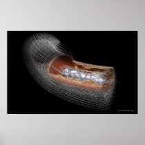 View of an angioplaty balloon in an artery print