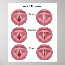 Vocal cord lesions Poster