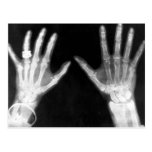 X-Ray Skeleton Hands & Jewellery - B&W Post Card