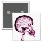 X-RAY SKULL BRAIN - PINK buttons