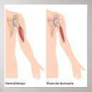 Recherche de anatomie musculaire posters Bras