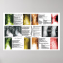 Recherche de lombaire posters Colonne vertébrale