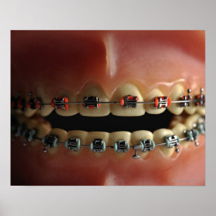 A dental model and Teeth braces Poster