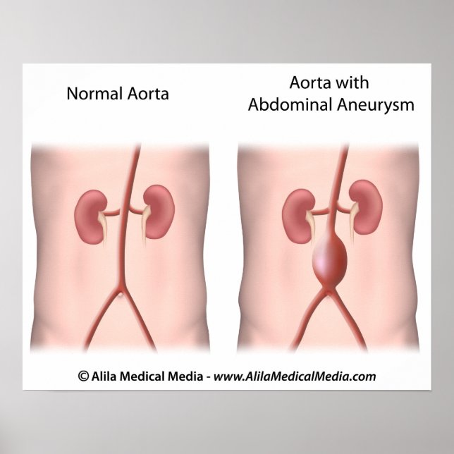 Abdominal Aortic Aneurysm poster (Front)