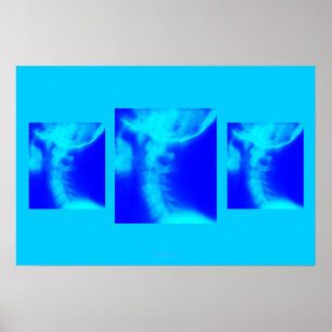 Affiche de chiropractie : Bleus cervicaux latéraux
