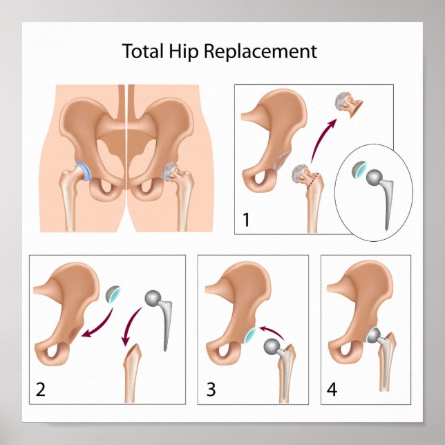 Affiche de chirurgie de remplacement de la hanche (Devant)