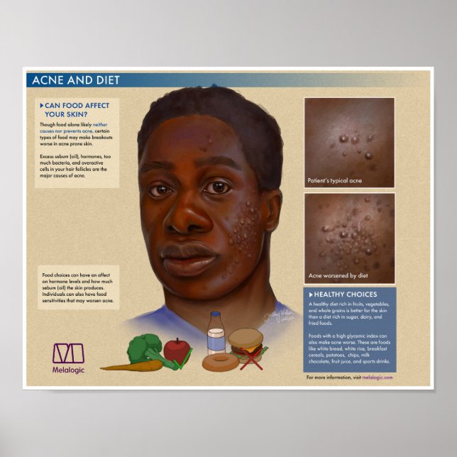 Affiche Médicale sur l'acné et le régime Melalogiq (Devant)
