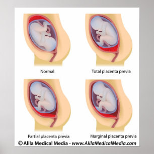 Affiche Placenta prea