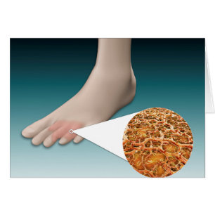 Anatomie Des Fungus Pieds Avec Agrandissement Micr