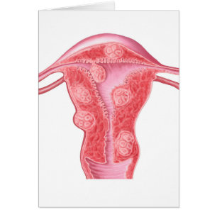 Anatomie des tumeurs fibroïdes dans l'utérus