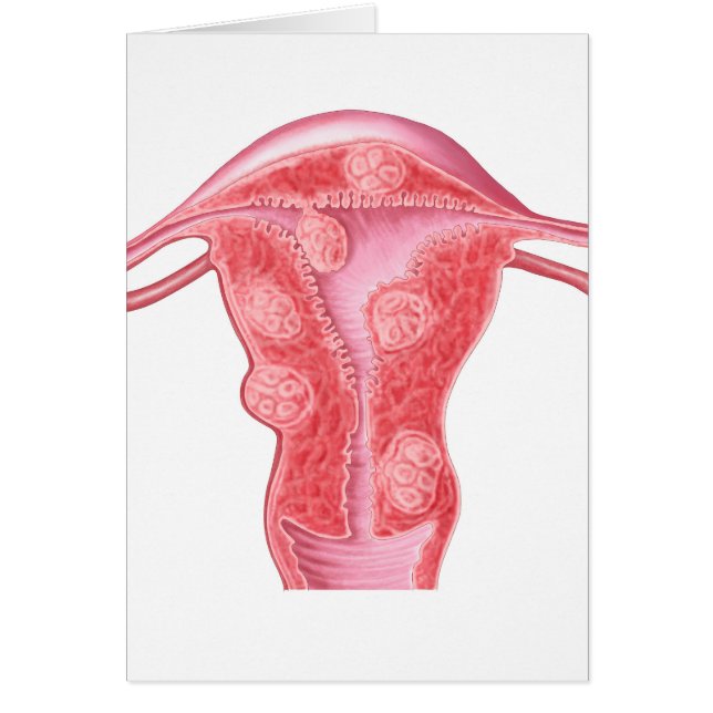 Anatomie Des Tumeurs Fibroïdes Dans L'Utérus Fémin (Devant)