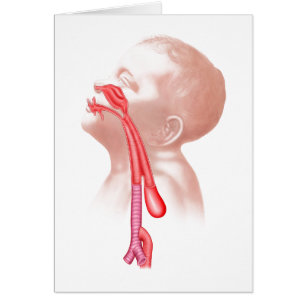 Anatomie D'Une Fistule Trachéesophagienne