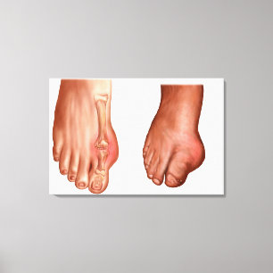 Anatomy Of A Swollen Foot Canvas Print