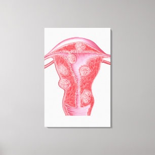 Anatomy Of Fibroid Tumours In Female Uterus Canvas Print