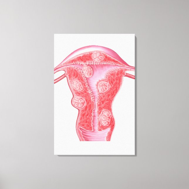 Anatomy Of Fibroid Tumours In Female Uterus Canvas Print (Front)