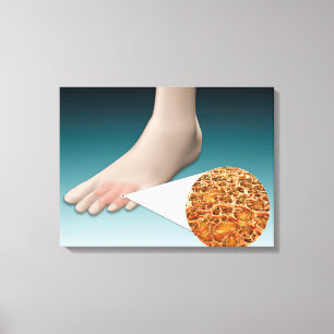 Anatomy Of Foot Fungus With Microscopic Close-Up Canvas Print