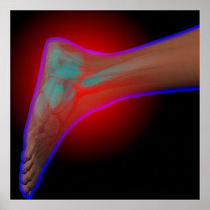 Ankle Pain Poster