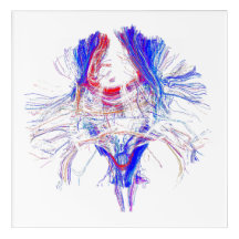 Cerveau et Tracktography