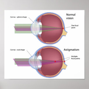 Astigmatisme, un défaut oculaire commun Poster
