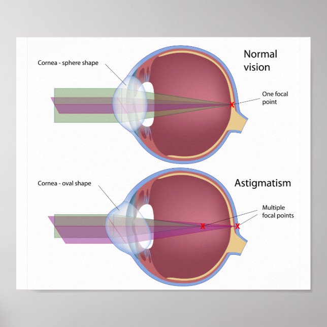 Astigmatisme, un défaut oculaire commun Poster (Devant)