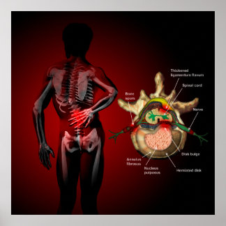 Back pain poster