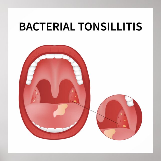 Bacterial tonsillitis poster (Front)